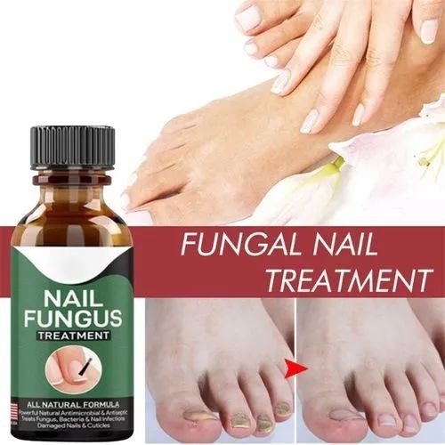 Fast Nail Fungus Treatment Serum – (All-Natural Formula)