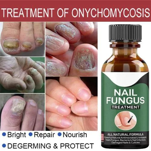 Fast Nail Fungus Treatment Serum – (All-Natural Formula)