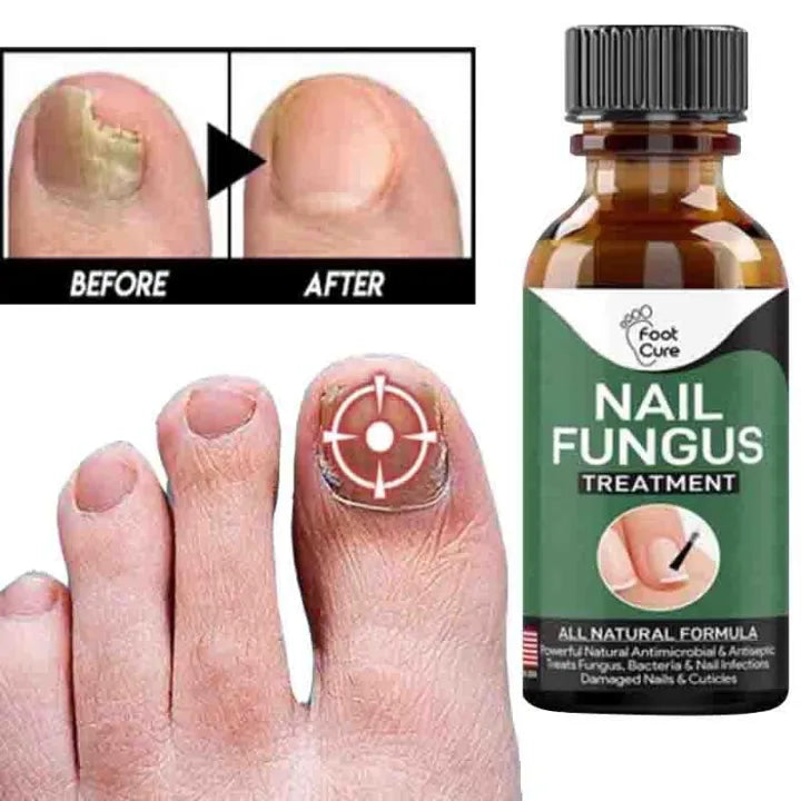 Fast Nail Fungus Treatment Serum – (All-Natural Formula)