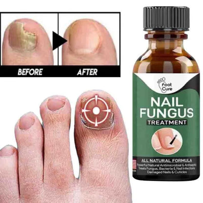 Fast Nail Fungus Treatment Serum – (All-Natural Formula)